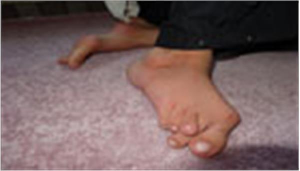 توسط موسسه خیریه عترت بوتراب در استان لرستان؛  دختر سیزده ساله مددجو درمان می‌شود